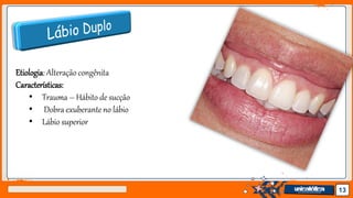 Jens Martensson 13
Etiologia: Alteração congênita
Características:
• Trauma – Hábito de sucção
• Dobra exuberante no lábio
• Lábio superior
 