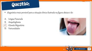 Jens Martensson 17
• diagnóstico mais provável para a situação clínica ilustrada na figura abaixo é de:
A. Língua Fissurada
B. Anquiloglossia
C. Glossite Migratória
D. Varicosidades
 