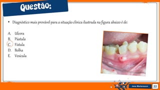 Jens Martensson 22
• Diagnóstico mais provável para a situação clínica ilustrada na figura abaixo é de:
A. Ulcera
B. Pústula
C. Fístula
D. Bolha
E. Vesícula
 