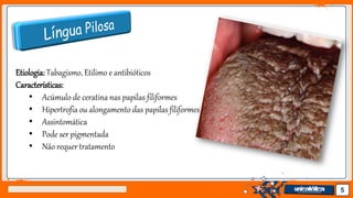 Jens Martensson 5
Etiologia:Tabagismo, Etilimo e antibióticos
Características:
• Acúmulo de ceratina nas papilas filiformes
• Hipertrofia ou alongamento das papilas filiformes
• Assintomática
• Pode ser pigmentada
• Não requer tratamento
 