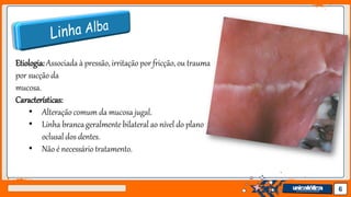 Jens Martensson 6
Etiologia:Associada à pressão, irritação por fricção, ou trauma
por sucção da
mucosa.
Características:
• Alteração comum da mucosa jugal.
• Linha brancageralmente bilateral ao nível do plano
oclusal dos dentes.
• Não é necessário tratamento.
 