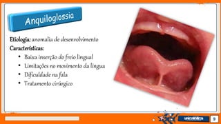 Jens Martensson 9
Etiologia: anomalia de desenvolvimento
Características:
• Baixa inserção do freio lingual
• Limitações no movimento da língua
• Dificuldade na fala
• Tratamento cirúrgico
 