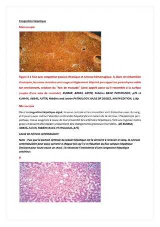 Congestion hépatique
Macroscopie
Figure 3-1 Foie avec congestion passive chronique et nécrose hémorragique. A, Dans cet échantillon
d'autopsie, les zones centrales sont rouges et légèrement déprimé par rapport au parenchyme viable
tan environnant, création du "foie de muscade" (ainsi appelé parce qu'il ressemble à la surface
coupée d'une noix de muscade). KUMAR, ABBAS, ASTER, Robbins BASIC PATHOLOGIE, p76 et
KUMAR, ABBAS, ASTER, Robbins and cotran PATHOLOGIC BASIS OF DEASES, NINTH EDITION, 116p
Microscopie
Dans la congestion hépatique aiguë, la veine centrale et les sinusoïdes sont distendues avec du sang,
et il peut y avoir même l’abandon central des hépatocytes en raison de la nécrose. L’hépatocyte péri
portaux, mieux oxygénés à cause de leur proximité des artérioles hépatiques, font une hypoxie moins
grave et peuvent développer uniquement des changements graisseux réversibles. (DE KUMAR,
ABBAS, ASTER, Robbins BASIC PATHOLOGIE, p75)
Cause de nécrose centrilobulaire
Note : Puis que la portion centrale du lobule hépatique est la dernière à recevoir le sang, la nécrose
centrilobulaire peut aussi survenir à chaque fois qu’il y a réduction du flux sanguin hépatique
(incluant pour toute cause un choc) ; là nécessite l’inexistence d’une congestion hépatique
antérieur.
B
 