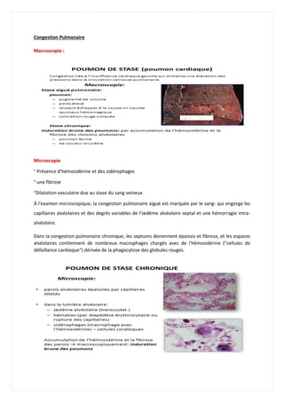 Congestion Pulmonaire
Macroscopie :
Microscopie
° Présence d’hémosidérine et des sidérophages
° une fibrose
°Dilatation vasculaire due au stase du sang veineux
À l'examen microscopique, la congestion pulmonaire aiguë est marquée par le sang- qui engorge les
capillaires alvéolaires et des degrés variables de l’œdème alvéolaire septal et une hémorragie intra-
alvéolaire.
Dans la congestion pulmonaire chronique, les septums deviennent épaissis et fibreux, et les espaces
alvéolaires contiennent de nombreux macrophages chargés avec de l'hémosidérine ("cellules de
défaillance cardiaque") dérivée de la phagocytose des globules rouges.
 