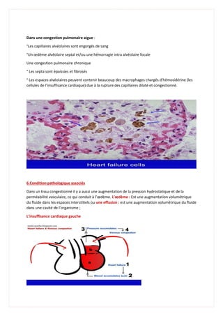 Dans une congestion pulmonaire aigue :
°Les capillaires alvéolaires sont engorgés de sang
°Un œdème alvéolaire septal et/ou une hémorragie intra alvéolaire focale
Une congestion pulmonaire chronique
° Les septa sont épaissies et fibrosés
° Les espaces alvéolaires peuvent contenir beaucoup des macrophages chargés d’hémosidérine (les
cellules de l’insuffisance cardiaque) due à la rupture des capillaires dilaté et congestionné.
6.Condition pathologique associés
Dans un tissu congestionné il y a aussi une augmentation de la pression hydrostatique et de la
perméabilité vasculaire, ce qui conduit à l’œdème. L’œdème : Est une augmentation volumétrique
du fluide dans les espaces interstitiels ou une effusion : est une augmentation volumétrique du fluide
dans une cavité de l’organisme ;
L’insuffisance cardiaque gauche
 