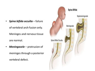 • Spina bifida occulta – failure
of vertebral arch fusion only.
Meninges and nervous tissue
are normal.
• Meningocele – protrusion of
meninges through a posterior
vertebral defect.
 
