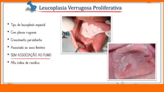Jens Martensson
• Tipo de leucoplasia especial
• Com placas rugosas
• Crescimento persistente
• Associada ao sexo feminino
• SEM ASSOCIAÇÃO AO FUMO
• Alto índice de recidiva
Leucoplasia Verrugosa Proliferativa
 