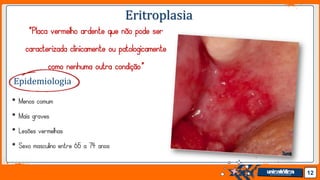Jens Martensson
Eritroplasia
“Placa vermelho ardente que não pode ser
caracterizada clinicamente ou patologicamente
como nenhuma outra condição”
• Menos comum
• Mais graves
• Lesões vermelhas
• Sexo masculino entre 65 a 74 anos
12
Epidemiologia
 