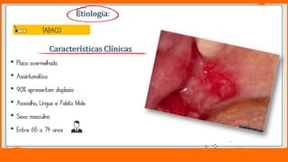 Jens Martensson
• Placa avermelhada
• Assintomática
• 90% apresentam displasia
• Assoalho, Língua e Palato Mole
• Sexo masculino
• Entre 65 a 74 anos
Etiologia:
Características Clínicas
TABACO
 