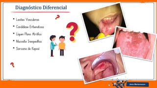 Jens Martensson
Diagnóstico Diferencial
• Lesões Vasculares
• Candidíase Eritematosa
• Líquen Plano Atrófico
• Mucosite Inespecífica
• Sarcoma de Kaposi
 