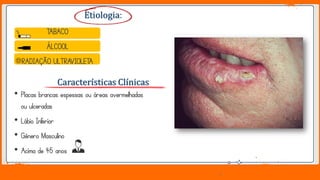 Jens Martensson
• Placas brancas espessas ou áreas avermelhadas
ou ulceradas
• Lábio Inferior
• Gênero Masculino
• Acima de 45 anos
Características Clínicas
TABACO
ÁLCOOL
RADIAÇÃO ULTRAVIOLETA
Etiologia:
 