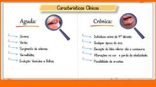 Jens Martensson
Características Clínicas
Aguda: Crônica:
Jovens;
Verão;
Surgimento de edemas;
Vermelhidão;
Evolução: Vesículas e Bolhas.
Indivíduos acima da 4º década;
Qualquer época do ano;
Elevação do lábio inferior até a comissura;
Alterações na cor e perda da elasticidade;
Possibilidade de erosões.
 