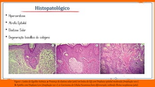Jens Martensson
• Hiperceratose
• Atrofia Epitelial
• Elastose Solar
• Degeneração basofílica do colágeno
Figura 1. Lesões de Queilite Actínica. a- Presença de elastose solar (seta) em lesões de QA com Displasia epitelial moderada (Ampliação 100×).
b-Epitélio com Displasia Leve (Ampliação 100 ×). c-Carcinoma de Células Escamosas bem diferenciado, exibindo ilhotas neoplásicas (seta).
Histopatológico
 