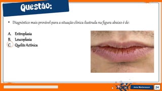Jens Martensson 24
• Diagnóstico mais provável para a situação clínica ilustrada na figura abaixo é de:
A. Eritroplasia
B. Leucoplasia
C. QueliteActínica
 