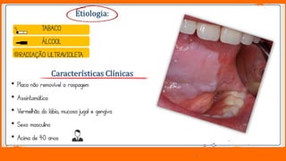 Jens Martensson
Etiologia:
• Placa não removível a raspagem
• Assintomática
• Vermelhão do lábio, mucosa jugal e gengiva
• Sexo masculino
• Acima de 40 anos
Características Clínicas
TABACO
ÁLCOOL
RADIAÇÃO ULTRAVIOLETA
 