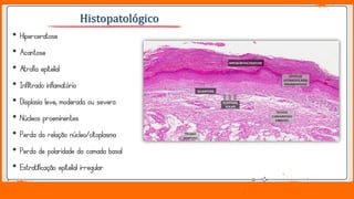 Jens Martensson
• Hiperceratose
• Acantose
• Atrofia epitelial
• Infiltrado inflamatório
• Displasia leve, moderada ou severa
• Núcleos proeminentes
• Perda da relação núcleo/citoplasma
• Perda de polaridade da camada basal
• Estratificação epitelial irregular
Histopatológico
 