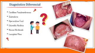 Jens Martensson
• Candidíase Pseudomembranosa
• Queimaduras
• Hiperceratose Focal
• Estomatite Nicotínica
• Mucosa Mordiscada
• Leucoplasia Pilosa
Diagnóstico Diferencial
 