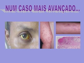 Anais SIDAVírus da Imunodeficiência Humana (VIH) O QUE É?A SIDA é um vírus que penetra no organismo por contacto com uma pessoa infectada.COMO É TRANSMITIDA? Relações sexuais