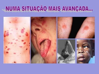 Vírus do papiloma humano