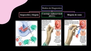 G7 Cancer De Cervix FINAL pptx g7-cancer-de-cervix-final-pptx