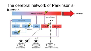 The cerebral network of Parkinson’s
tremor
 