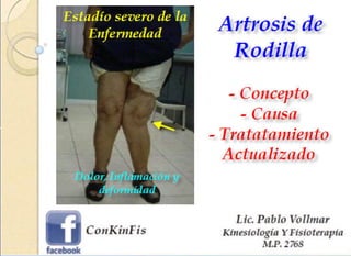 Artrosis de Rodilla - Gonartrosis