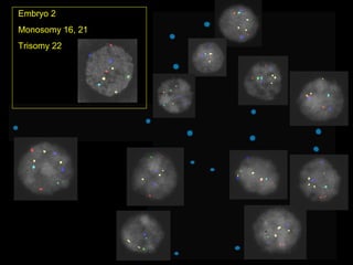 Embryo 2 
Monosomy 16, 21 
Trisomy 22 
 