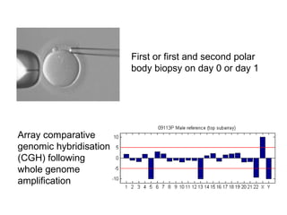First or first and second polar 
body biopsy on day 0 or day 1 
Array comparative 
genomic hybridisation 
(CGH) following 
whole genome 
amplification 
 