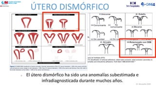 ÚTERO DISMÓRFICO
El útero dismórfico ha sido una anomalías subestimada e
infradiagnosticada durante muchos años.
Dr. Moratalla 2020
 