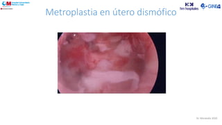 Metroplastia en útero dismófico
Dr. Moratalla 2020
 
