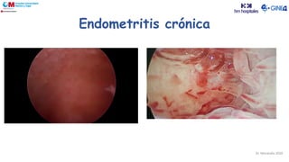 Endometritis crónica
Dr. Moratalla 2020
 