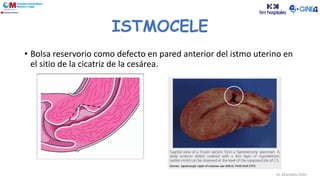 Dr. Moratalla 2020
ISTMOCELE
• Bolsa reservorio como defecto en pared anterior del istmo uterino en
el sitio de la cicatriz de la cesárea.
 