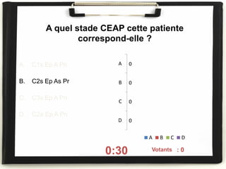 A quel stade CEAP cette patiente
correspond-elle ?
A. C1s Ep A Pn
B. C2s Ep As Pr
C. C3s Ep A Pn
D. C2a Ep A Pn
0:30 On voté : 0
0
0
0
0
A
B
C
D
A B C D
Votants
 