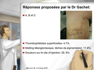 Réponses proposées par le Dr Gachet:
A, B et C
Thrombophlébites superficielles: 4.7%
Matting télangiectasique, tâches de pigmentation: 17,8%
Douleurs sur le site d’injection: 25, 6%
Jia et al. Br J of Surg 2007.
 