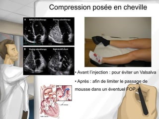Compression posée en cheville
• Avant l’injection : pour éviter un Valsalva
• Après : afin de limiter le passage de
mousse dans un éventuel FOP
 