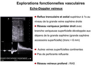 Echo-Doppler veineux
Explorations fonctionnelles vasculaires
Reflux tronculaire et ostial supérieur à 1s au
niveau de la grande veine saphène droite
Réseau variqueux jambier droit avec
branche variqueuse superficielle développée aux
dépens de la grande saphène (grande saphène
accessoire superficielle) (tronc = 6 mm)
Autres veines superficielles continentes
Pas de perforante refluante
Réseau veineux profond : RAS
 