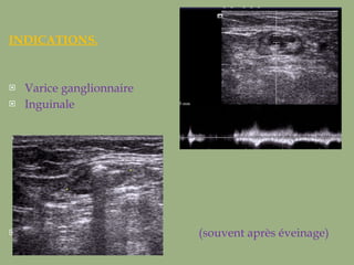INDICATIONS. Varice ganglionnaire Inguinale  (souvent après éveinage) 