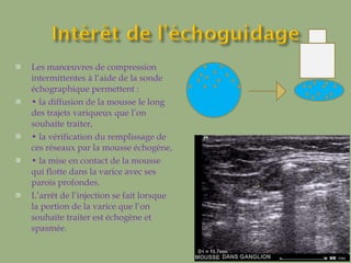 Les manœuvres de compression intermittentes à l’aide de la sonde échographique permettent : •  la diffusion de la mousse le long des trajets variqueux que l’on souhaite traiter, •  la vérification du remplissage de ces réseaux par la mousse échogène, •  la mise en contact de la mousse qui flotte dans la varice avec ses parois profondes.  L’arrêt de l’injection se fait lorsque la portion de la varice que l’on souhaite traiter est échogène et spasmée. 