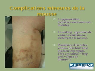 La pigmentation (saphènes accessoires sus-fasciales). La matting : apparition de varices secondaires au traitement à la mousse.  Persistance d’un reflux veineux plus haut situé, injection trop rapide? Trop concentrée ? Trop gros volume de mousse ?).  