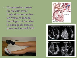 Compression  posée en cheville avant l’injection pour éviter un Valsalva lors de l’enfilage qui favorise le passage de mousse dans un éventuel FOP 