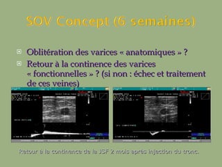 Oblitération des varices « anatomiques » ? Retour à la continence des varices « fonctionnelles » ? (si non : échec et traitement de ces veines) Retour à la continence de la JSF 2 mois après injection du tronc.   