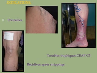 INDICATIONS. Périnéales  Troubles trophiques CEAP C5 Récidives après strippings 
