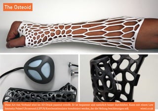 The Osteoid 
Diese Art von Verband wird im 3D-Druck passend erstellt. Er ist bequemer und natürlich besser durchlüftet. Kann mit einem Low 
Intensity Pulsed Ultrasound (LIPUS) Knochenstimulator kombiniert werden, der die Heilung beschleunigen soll. wired.co.uk 
 
