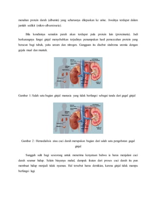 menahan protein darah (albumin) yang seharusnya dilepaskan ke urine. Awalnya terdapat dalam
jumlah sedikit (mikro-albuminuria).
Bila kondisinya semakin parah akan terdapat pula protein lain (proteinuria). Jadi
berkurangnya fungsi ginjal menyebabkan terjadinya penumpukan hasil pemcecahan protein yang
beracun bagi tubuh, yaitu ureum dan nitrogen. Gangguan itu disebut sindroma uremia dengan
gejala mual dan muntah.
Gambar 1: Salah satu bagian ginjal manusia yang tidak berfungsi sebagai tanda dari gagal ginjal
Gambar 2 : Hemodialisis atau cuci darah merupakan bagian dari salah satu pengobatan gagal
ginjal
Sungguh sulit bagi seseorang untuk menerima kenyataan bahwa ia harus menjalani cuci
darah seumur hidup. Selain biayanya mahal, dampak ikutan dari proses cuci darah itu pun
membuat hidup menjadi tidak nyaman. Hal tersebut harus demikian, karena ginjal tidak mampu
berfungsi lagi.
 