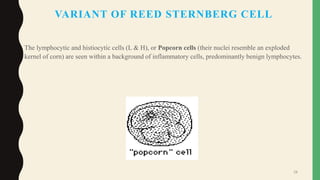 VARIANT OF REED STERNBERG CELL
• The lymphocytic and histiocytic cells (L & H), or Popcorn cells (their nuclei resemble an exploded
kernel of corn) are seen within a background of inflammatory cells, predominantly benign lymphocytes.
28
 