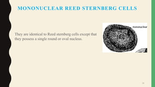 MONONUCLEAR REED STERNBERG CELLS
They are identical to Reed sternberg cells except that
they possess a single round or oval nucleus.
29
 
