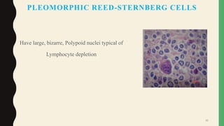PLEOMORPHIC REED-STERNBERG CELLS
Have large, bizarre, Polypoid nuclei typical of
Lymphocyte depletion
30
 