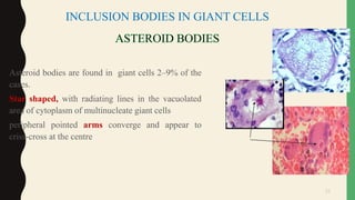33
• Asteroid bodies are found in giant cells 2–9% of the
cases.
• Star shaped, with radiating lines in the vacuolated
area of cytoplasm of multinucleate giant cells
• peripheral pointed arms converge and appear to
criss-cross at the centre
INCLUSION BODIES IN GIANT CELLS
 