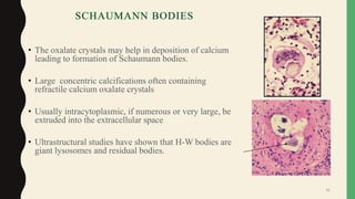 • The oxalate crystals may help in deposition of calcium
leading to formation of Schaumann bodies.
• Large concentric calcifications often containing
refractile calcium oxalate crystals
• Usually intracytoplasmic, if numerous or very large, be
extruded into the extracellular space
• Ultrastructural studies have shown that H-W bodies are
giant lysosomes and residual bodies.
35
 