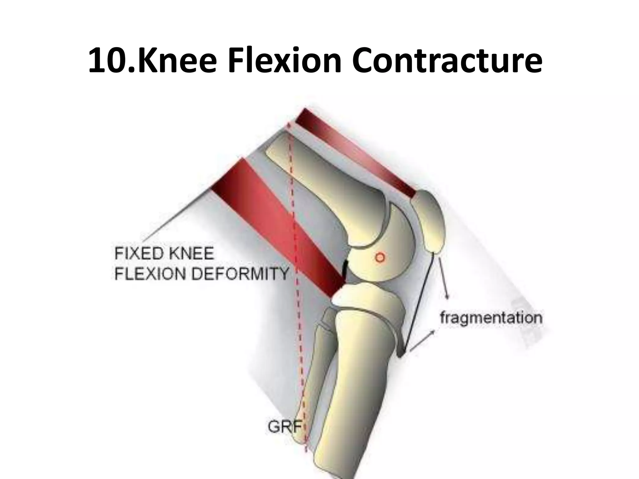 10.Knee Flexion Contracture
 